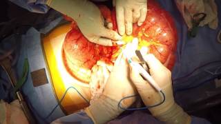 Cecal Volvulus Cecal Volvulus