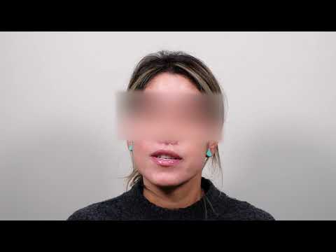 New York Lip Lift Testimonial