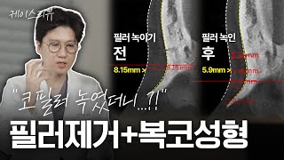 “필러 녹이고 다시 디자인했어요” 실리콘 2mm 콧대+복코 개선 코성형 | 자연스러운 입체감 회복 케이스리뷰
