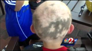 Teacher shaves head to support student with Alopec