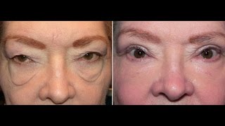 preview picture of video 'Tampa Plastic Surgeons l Eyelid Surgery Tampa l Laser Festoon Treatments'