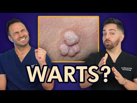 HOW TO TREAT WARTS LIKE A DERMATOLOGIST | EVERYTHING ABOUT WARTS