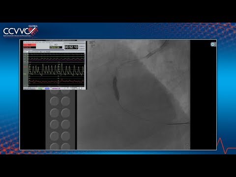 PCI of mRCA with Orbital Atherectomy - 2018 CCC Live Case 6