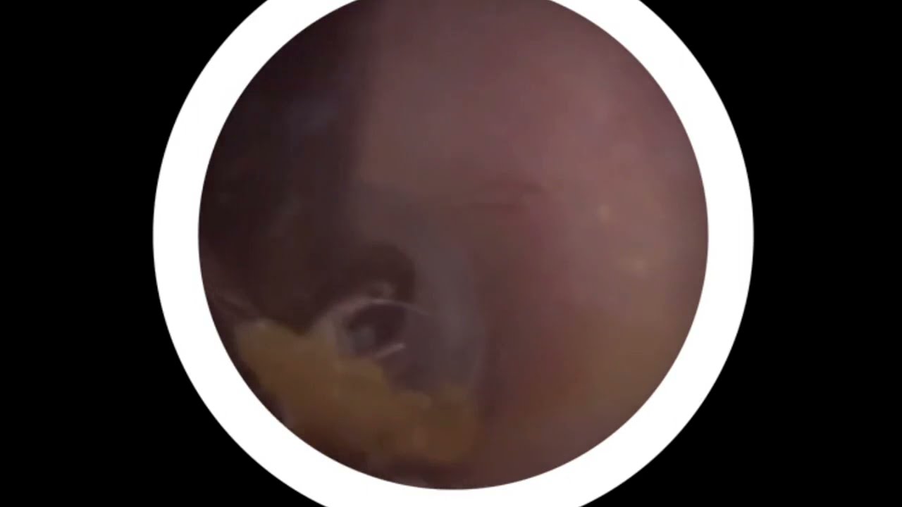 平时耳朵不痒吗？能长这么多 #采耳 #强迫症 #耳朵清洁 快手