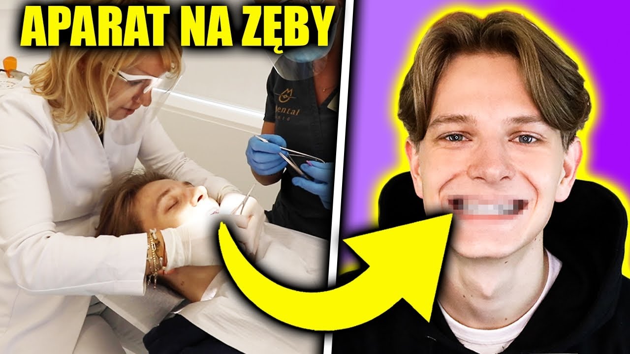 ZAŁOŻYŁEM APARAT NA ZĘBY 😱 *jaki wybrać ile to kosztuje* | Dominik Rupiński