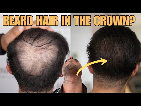 Can You Transplant Beard Hair In The Crown? Dr. Felipe Pittella Answers