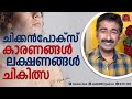 Chickenpox Causes Symptoms Treatment