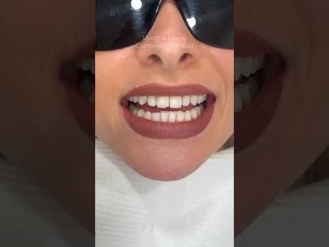 Upper & Lower Composite Bonding Makeover ❤️