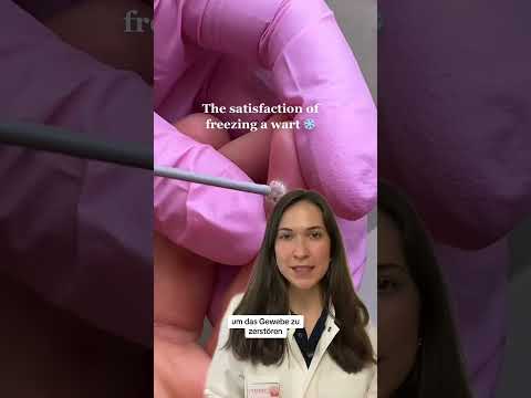 This is how warts are frozen off! l DERMAFY #shorts