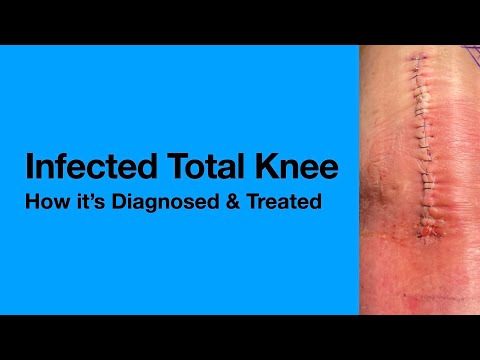 Infected Knee Implants: What Patients Must Know