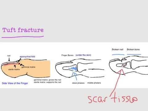 BoneTalks - FingerTip and Nailbed Injuries (Tuft Fracture)