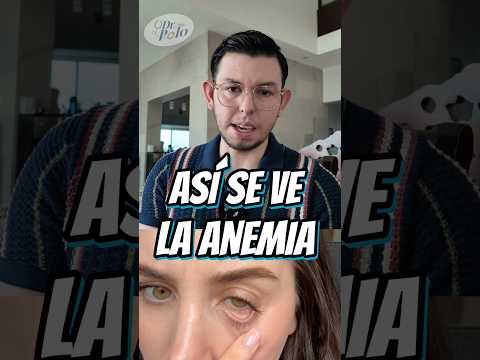 SINTOMAS de ANEMIA!!! 🩸🩸🩸 más en IG #medicina #sabiasque #curiosidades