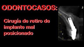 Retiro de implante dental: oseo integrado pero mal posicionado Vol 1