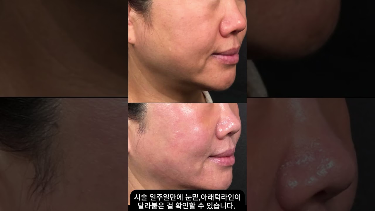 울트라클리어 엘리트 시술효과 전후사진