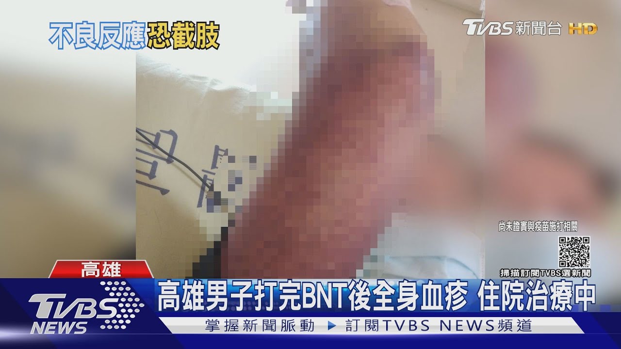 打完BNT!女學生傳雙腿需截肢 50歲男全身血疹