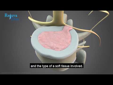 Non-Surgical Spinal Decompression Dublin Physiotherapy Clinic