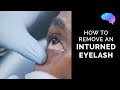 How to Remove an Inturned Eyelash | Eyelash Epilation