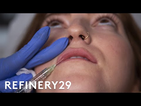 Ich habe mir zum ersten Mal Lippenfüller spritzen lassen | Macro Beauty | Refinery29