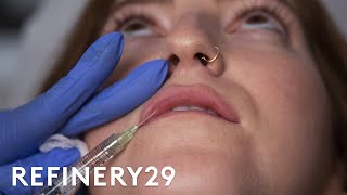 I Got Lip Filler Injections For The First Time | Macro Beauty | Refinery29