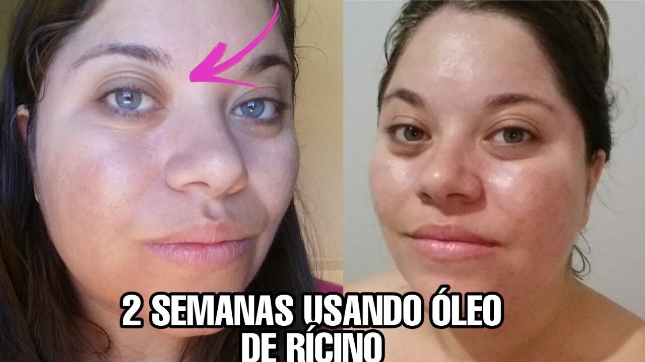 Watch Now ÓLEO RÍCINO NA SOBRANCELHAS | EM 2 SEMANAS - ANTES E DEPOIS ÓLEO RÍCINO NA SOBRANCELHAS | EM 2 SEMANAS - ANTES E DEPOIS