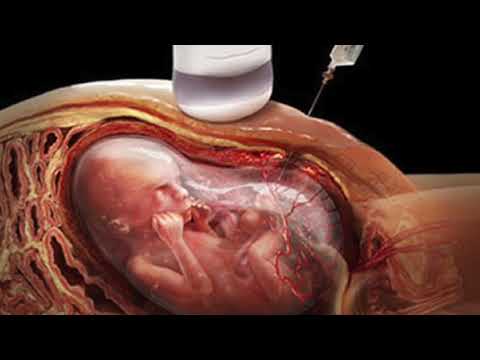 Amniocentesis (Explained)