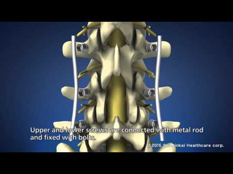 Treatment of lower back pain (PLF Therapy)