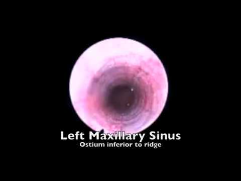 Balloon Dilation of Maxillary Sinus