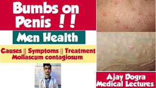 Bumbs on Penis || Men&#39;s  Health || Mollascum Contagiosum  || Causes || Symptoms  || Treatment