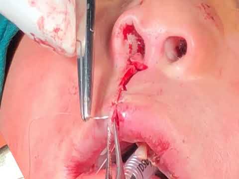 Cleft lip suturing