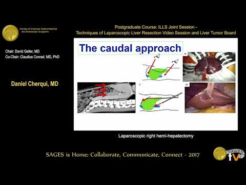 Laparoscopic Right Hemi Hepatectomy