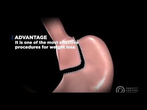 The Highly Effective Gastric Bypass Surgery at Obesity Control Center