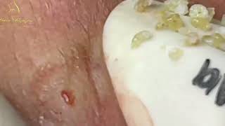 Loan Nguyen Acne Treatment 1396h