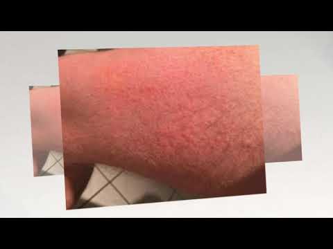 Die Salbe das Ekzem zu behandeln Die Behandlung moknuschtschich des Ekzems von den Antibiotika