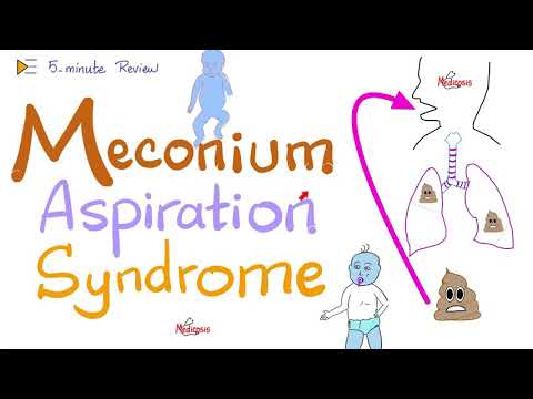 Meconium Aspiration Syndrome (MAS) | 5-Minute Review