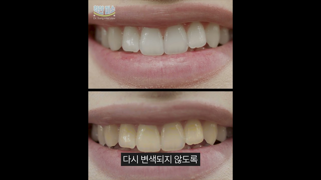 1주 만에 치아 하얘지는 성분