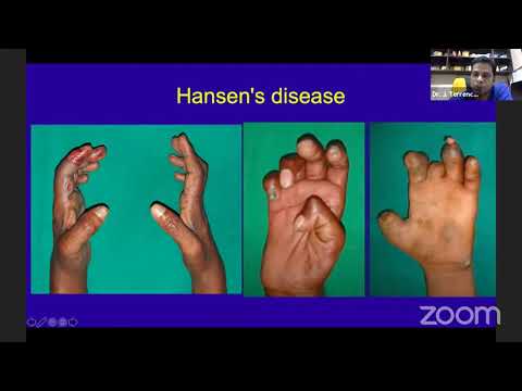 Clinical Examination of Hand- Ulnar Nerve