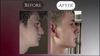 ⚡️ HOW TO CHANGE YOUR NOSE WITHOUT SURGERY! 🔥