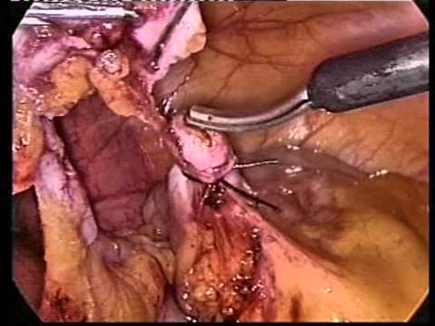 Apendicitis Aguda por Laparoscopía - Centro Laparoscópico Dr. Ballesta - Centro Laparoscópico Dr. Ballesta