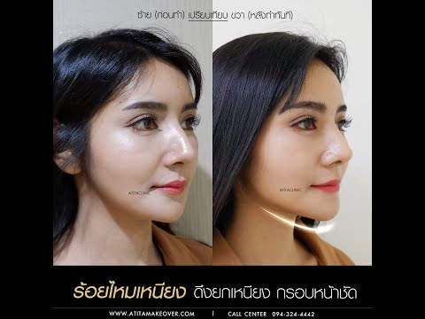 ร้อยไหม คอ ล ลา เจน