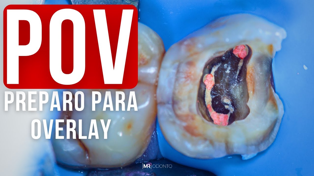 PREPARO PARA OVERLAY