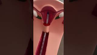 IUD Insertion