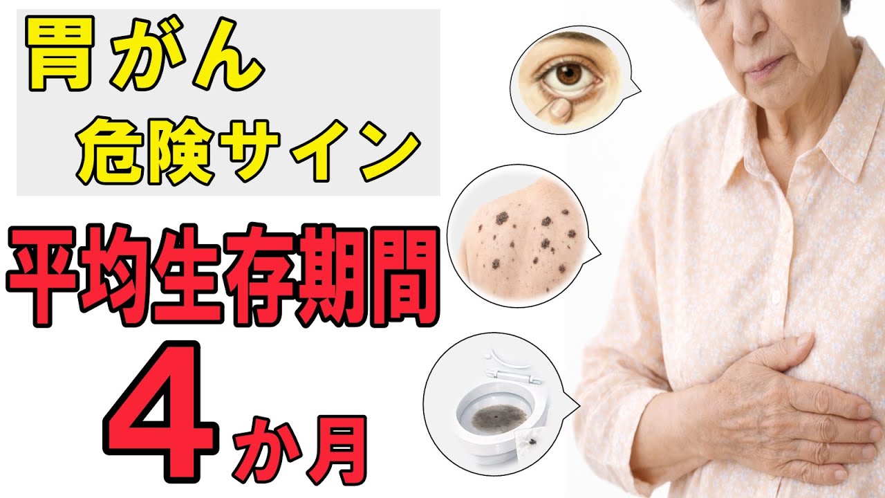 【胃がん】危険サイン５選と完全予防法を消化器内科医が解説