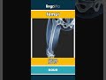 femur - 股骨 video thumbnail