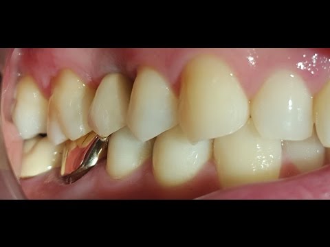 Dental Implant Surgery - Integra Dental Albania