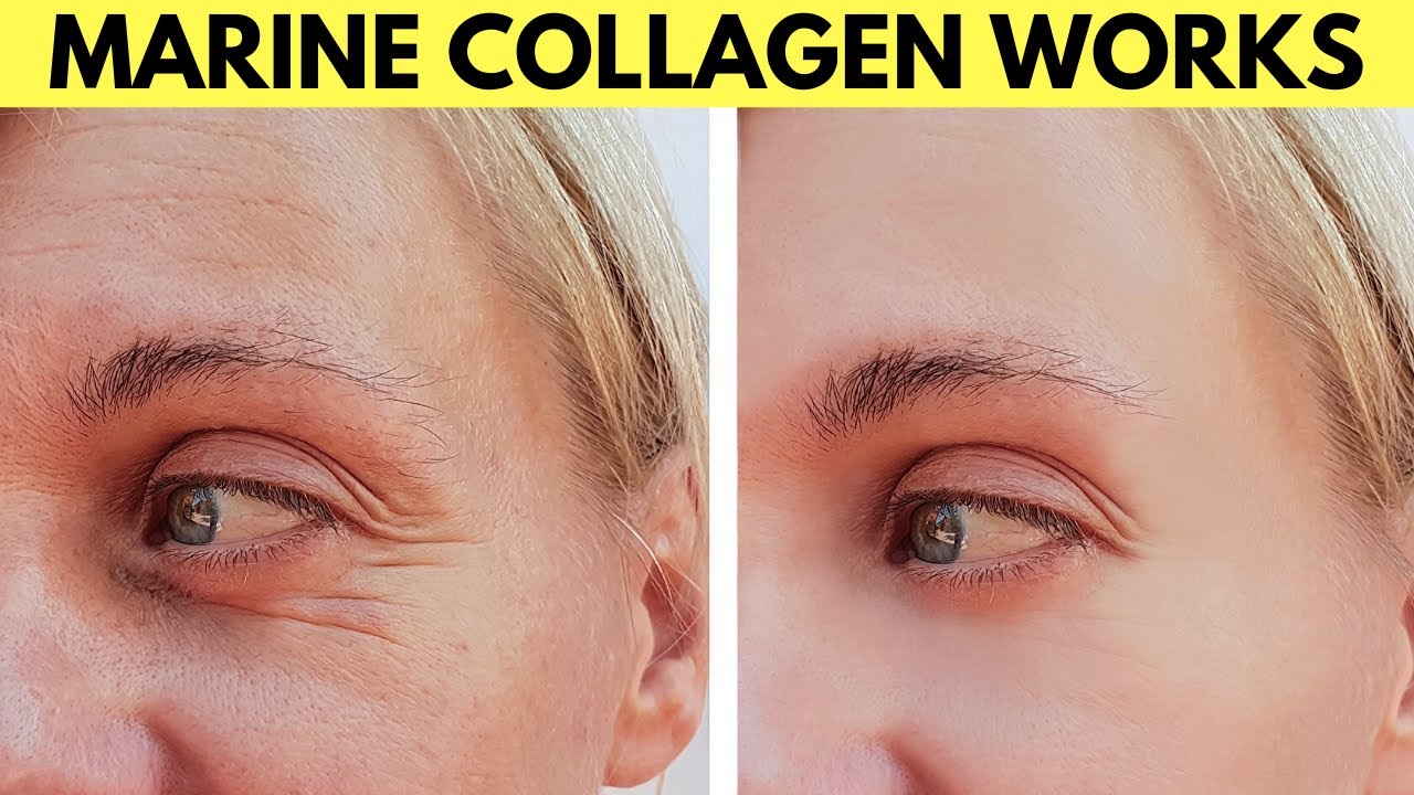 Marine collagen before and after