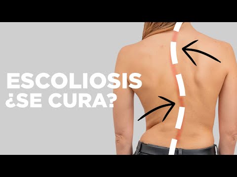 La ESCOLIOSIS ¿se CURA SOLA?