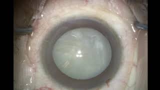 Video: Dr. David Chang: 20 ZEPTO® Complicated Cataract Cases