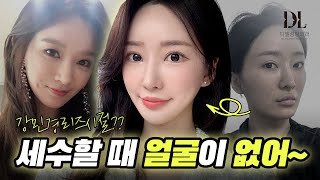 강민경 닮은꼴! | 중안부 줄이는 성형 후기 대공개‼️