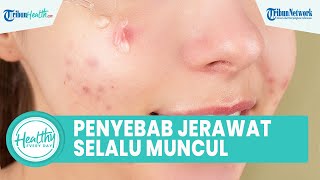 Penyebab Pemasalahan Kulit Berjerawat Muncul Terus Menerus, Satu di antaranya Adanya Sebum
