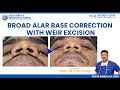 broad alar base correction with weir excision